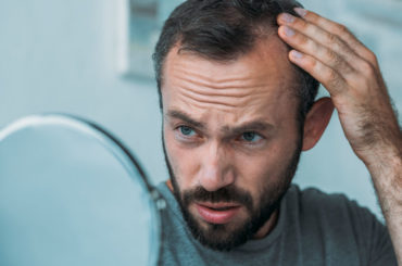 alopecia androgénica