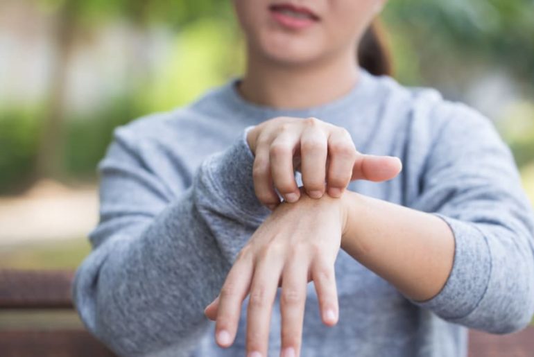 psoriasis
